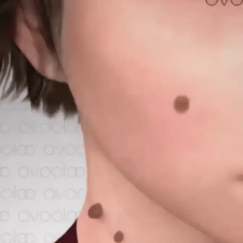Wart-Removal | Elimina Verrugas en días sin molestias