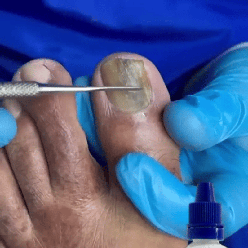 Nail Cure Pro | Tratamiento avanzado para hongos en las uñas