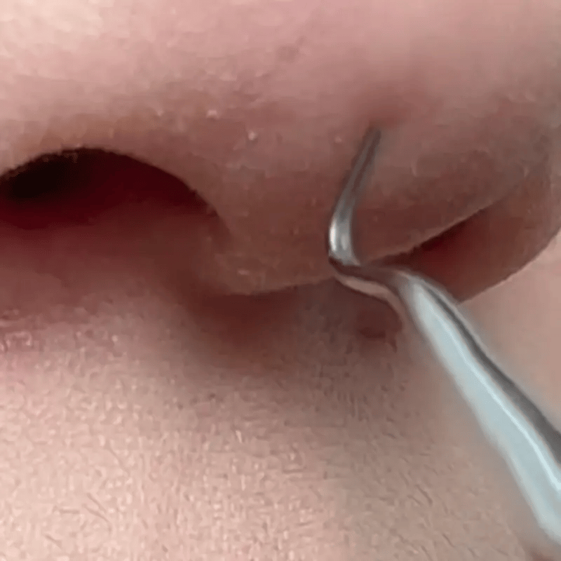 Espinillas Vanish | Pinzas ultrafinas para espinillas * 8 piezas