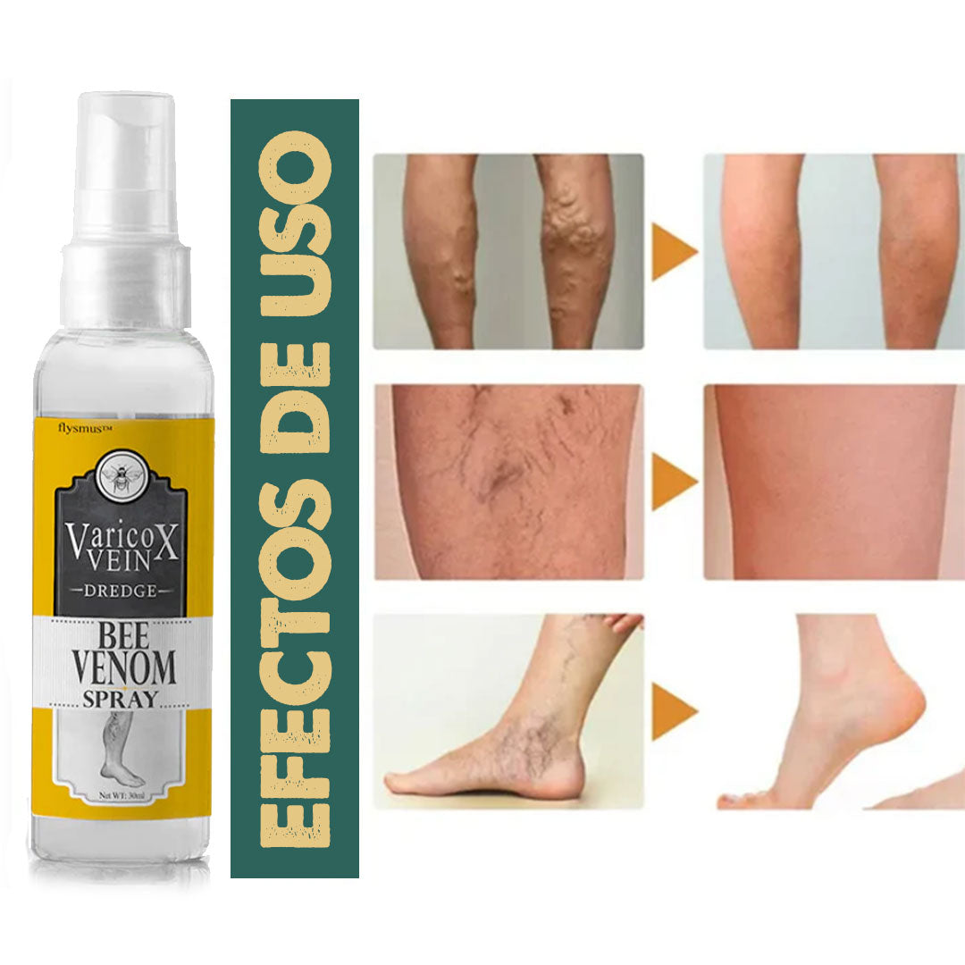 VeinX Varicose X2 UNIDADES | Dile adiós a las venas varicosas