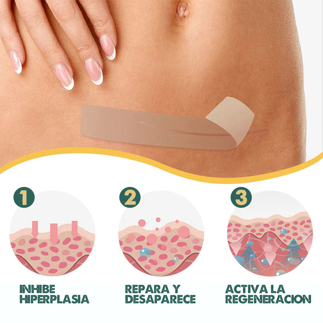 Silicone Marks Sheet | Adiós cicatrices y líneas de expresión desde la primera semana