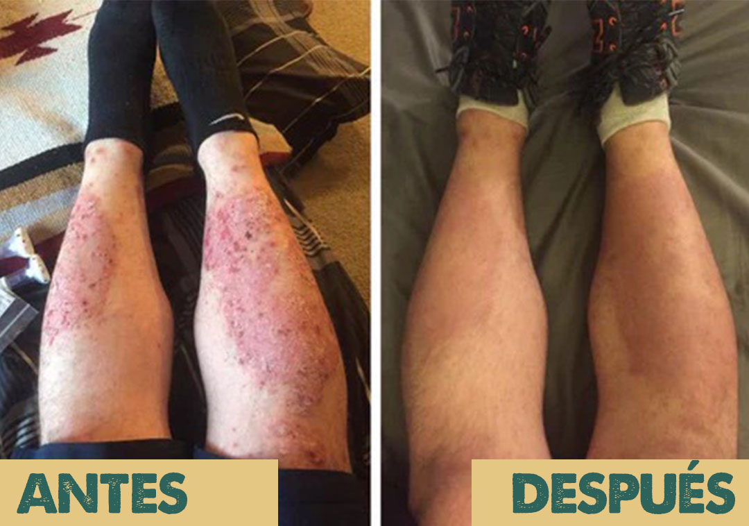 Eczema & Psoriasis Cream X2 UNIDADES | Dile adiós a la irritación y molestias