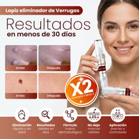 Removedor Rápido de Verrugas y Acné con Punta de Precisión - Pack 2 - 1
