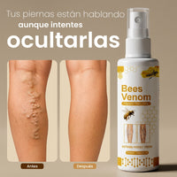 Crema de Alivio Intenso para Piernas: Dile adiós a Varices y Hinchazón | Alivio instantáneo - 1