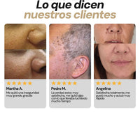 Removedor Rápido de Verrugas y Acné con Punta de Precisión - Pack 2 - 6