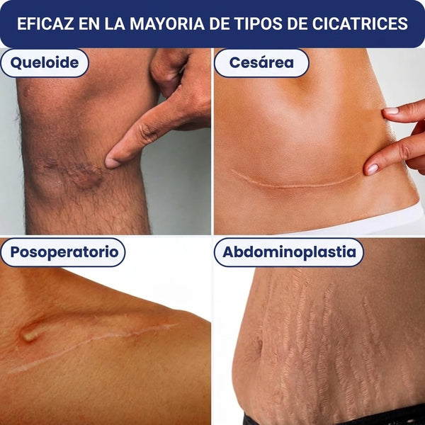 Mujer con cicatriz en la piel visiblemente reducida