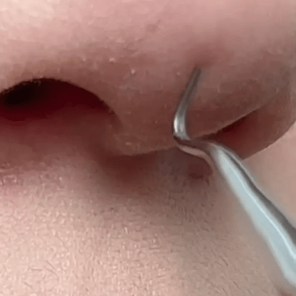 Espinillas Vanish | Pinzas ultrafinas para espinillas * 8 piezas