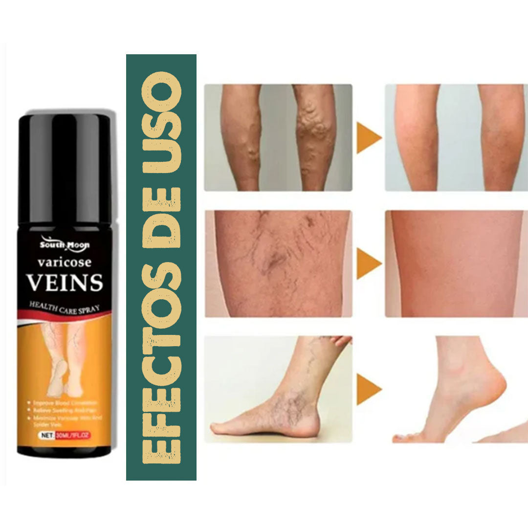 VeinX Varicose X2 UNIDADES | Dile adiós a las venas varicosas