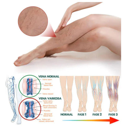 VeinX Varicose X2 UNIDADES | Dile adiós a las venas varicosas