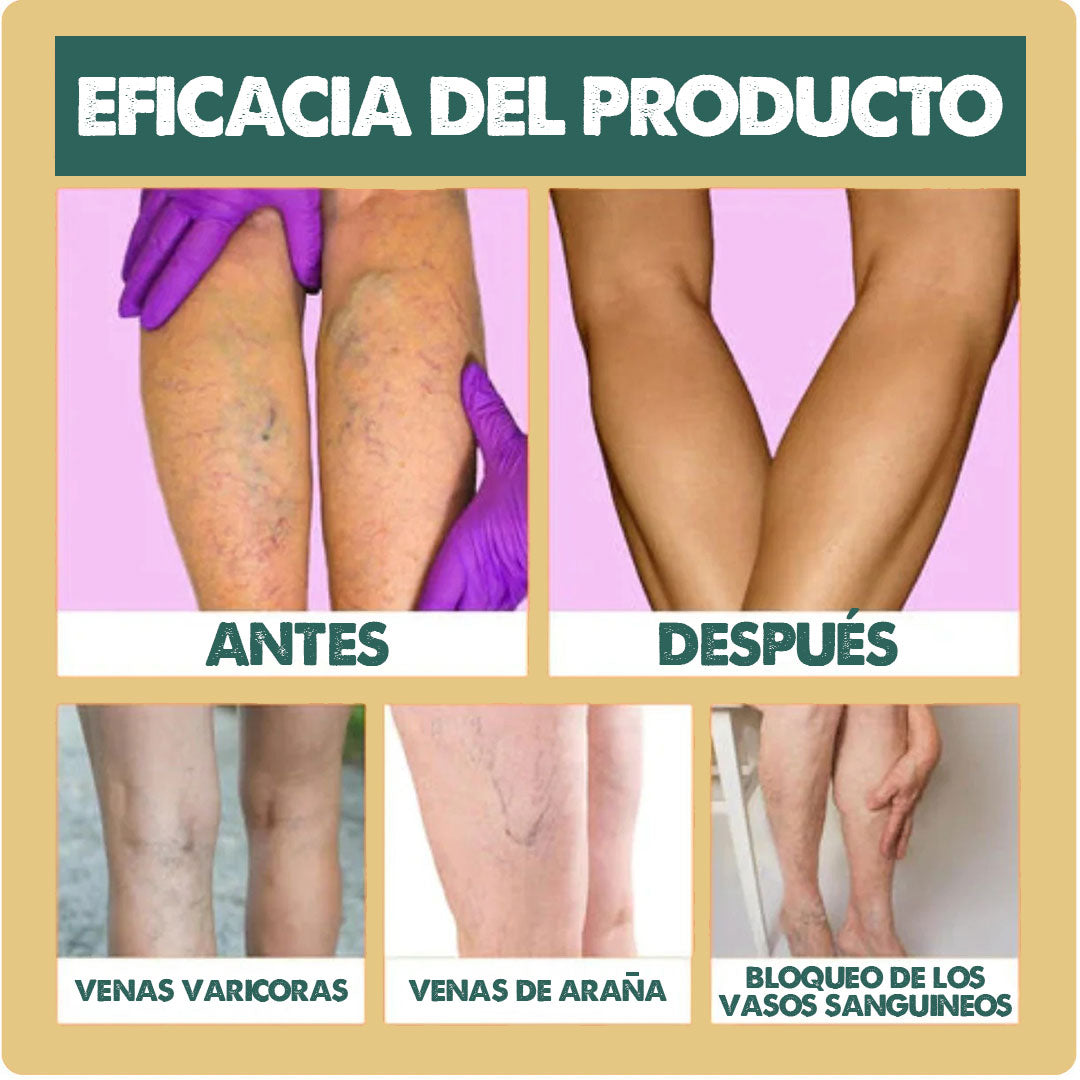 VeinX Varicose X2 UNIDADES | Dile adiós a las venas varicosas